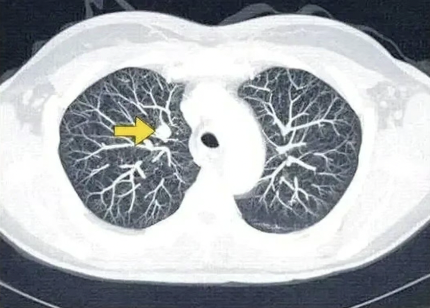 这4个症状出现2个，有可能是肺癌，建议尽快做个CT，查查肺