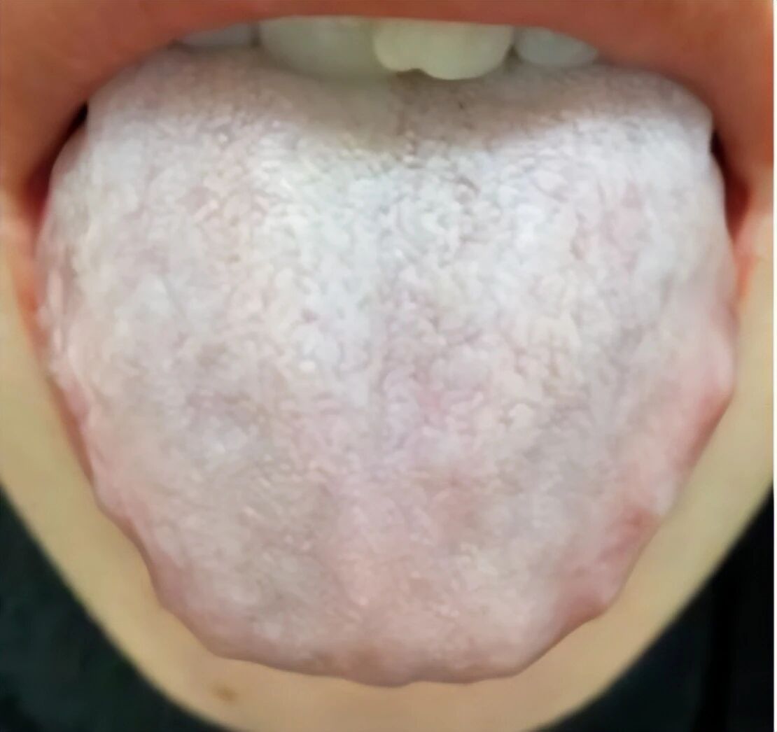 痰湿体质的患者必须要管住嘴！这4类食物，吃得越多肿瘤长得越快